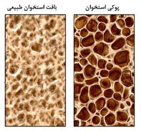 8 توصیه طلایی خانم ها برای پیشگیری از پوکی استخوان