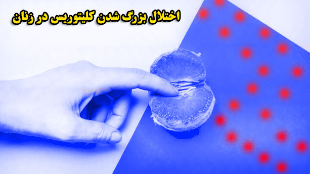 اختلال بزرگ شدن کلیتوریس در زنان + درمان بزرگ شدن کلیتوریس