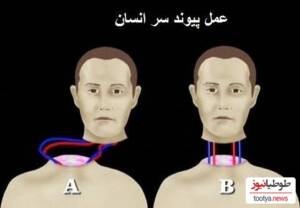 تکنولوژی شگفت‌انگیز و عجیب تعویض و پیوند سر و بدن!+ فیلم