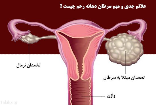 علائم جدی و مهم سرطان دهانه رحم چیست ؟