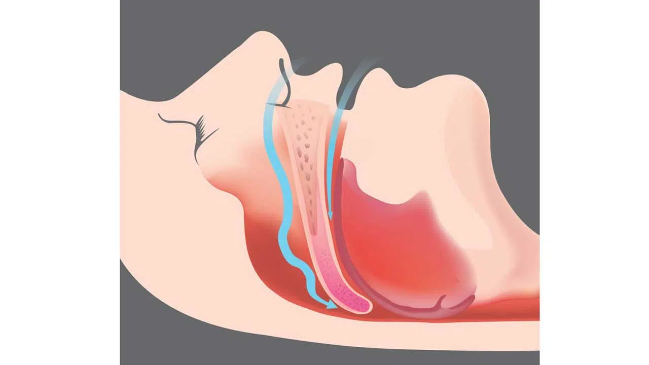 آپنه خواب باعث مشکلات حافظه می شود