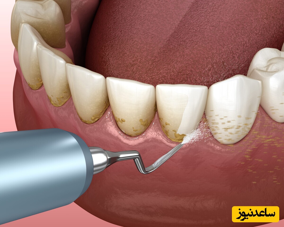 آیا جرمگیری به مینای دندان آسیب می زند؟ / فواید جرمگیری منظم دندان