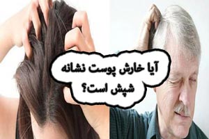 خارش سر نشانه شپش است؟ علت های خارش پوست سر