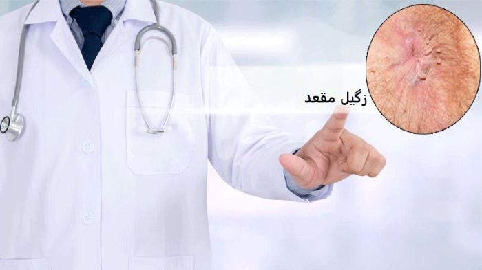 زگیل تناسلی و زگیل مقعد، شایع ترین بیماری‌های آمیزشی