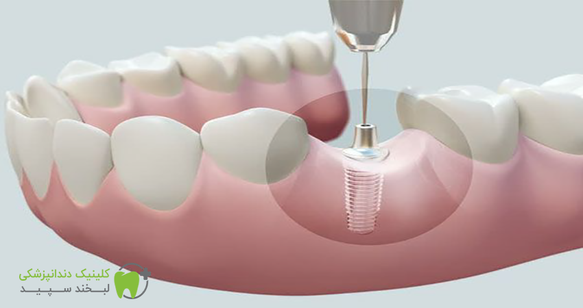 پرطرفدارترین خدمات زیبایی دندانپزشکی + قیمت آنها